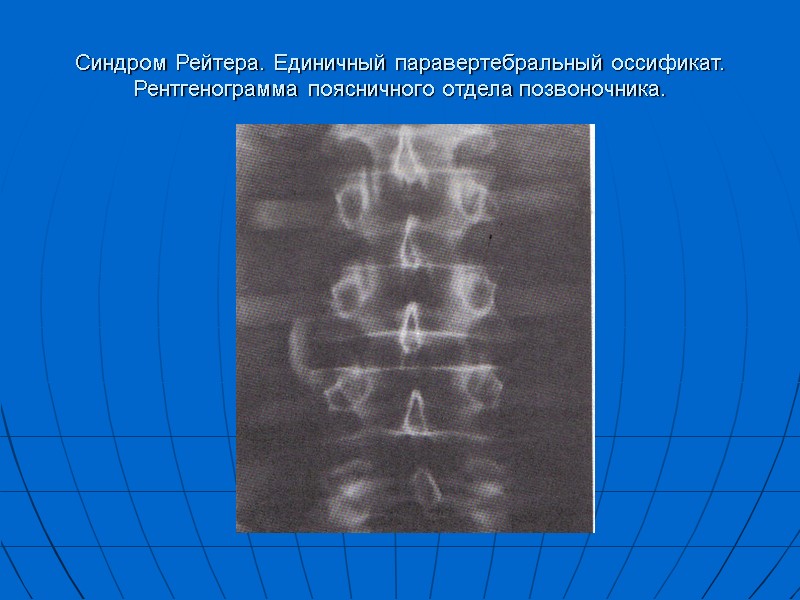 Синдром Рейтера. Единичный паравертебральный оссификат. Рентгенограмма поясничного отдела позвоночника.